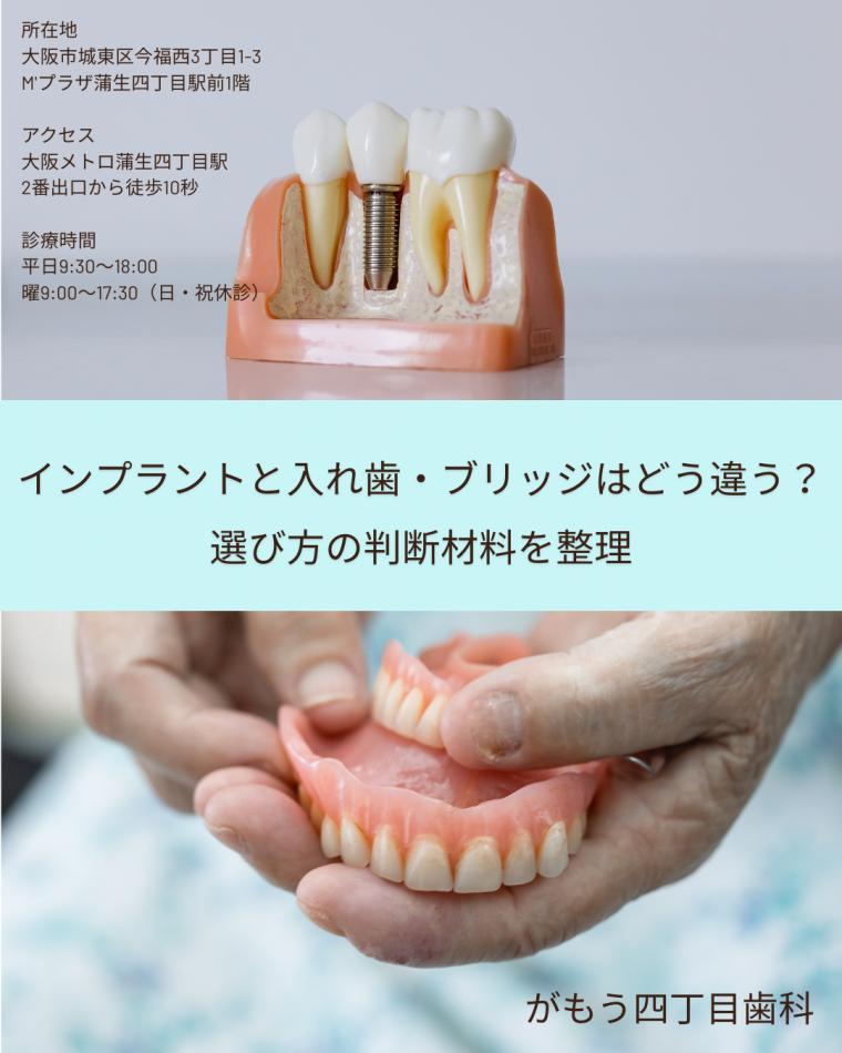 インプラントと入れ歯・ブリッジはどう違う？選び方の判断材料を整理