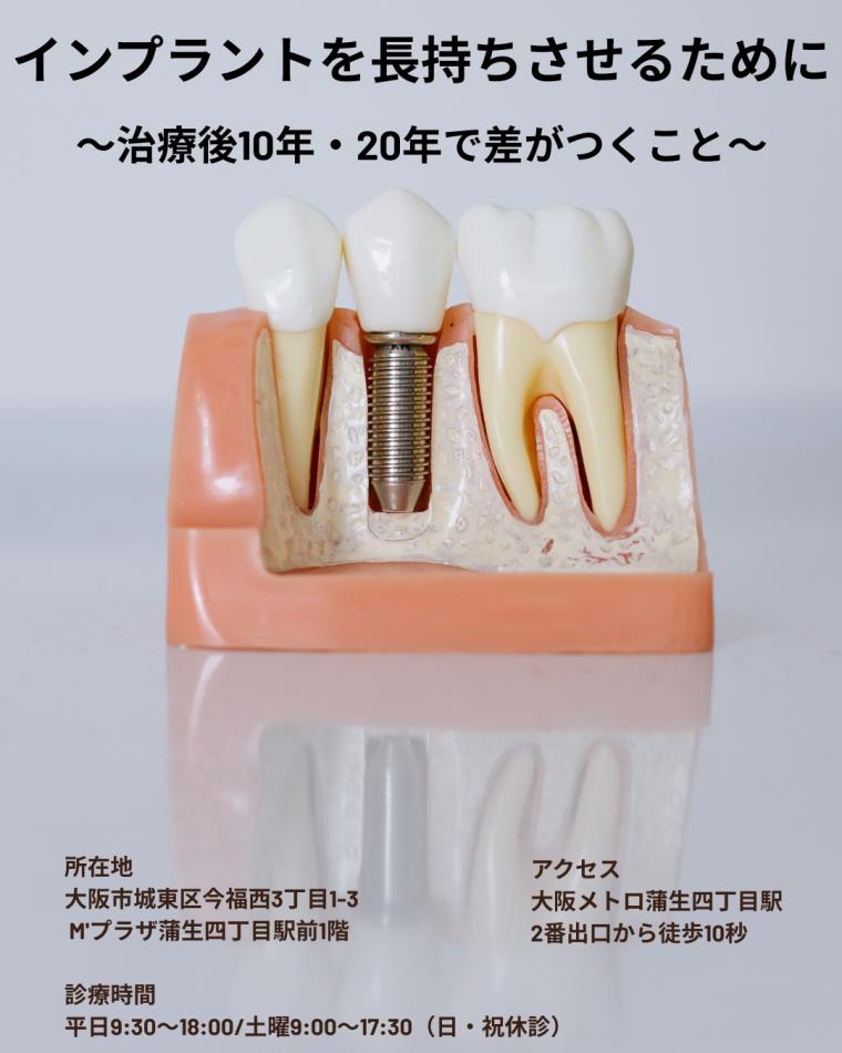 インプラントを長持ちさせるために｜治療後10年・20年で差がつくこと
